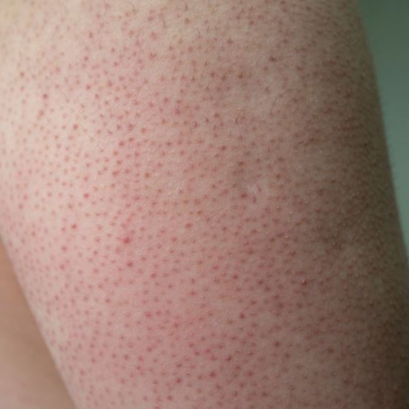 Ácido Glicólico para una piel radiante keratosis pilaris